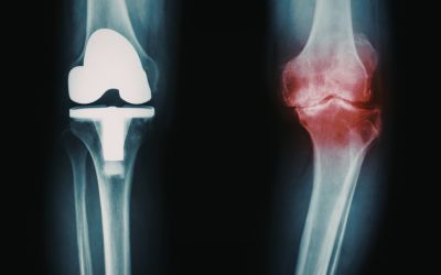 Rehabilitación pide un itinerario claro en la artrosis